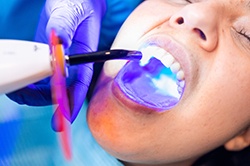 a patient having UV light placed up to their tooth