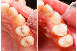 before and after image of two teeth that have received fillings