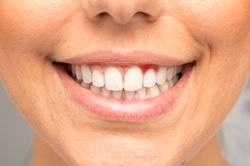 Close-up of smile with signs of gum disease in Weyauwega, WI