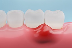 Illustration of teeth and inflamed gums