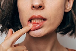 Woman pulling down lip to show gum inflammation