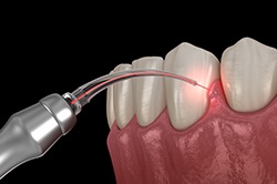 Illustration of laser being used to treat gum disease